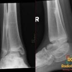 X-ray of distal tibiofibular diaphyseal synostosis in right leg