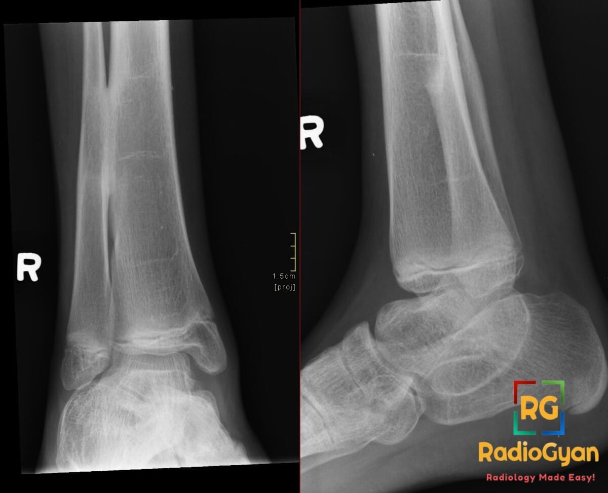 X-ray of distal tibiofibular diaphyseal synostosis in right leg