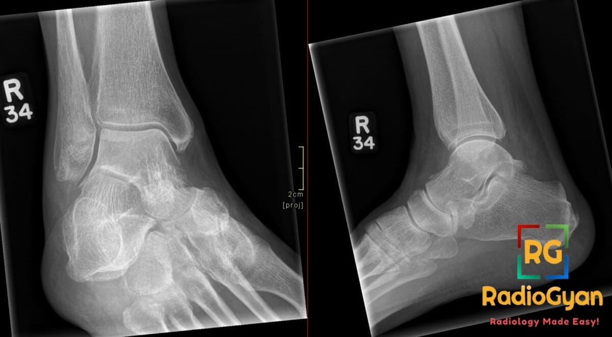 Ankle X-ray showing an avulsion fracture on the dorsal aspect of the talus, clearly visible in both views.