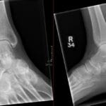 Lateral and oblique X-ray views of the ankle showing a dorsal talar avulsion fracture.