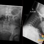 X-ray of spine showing anteroinferior beaking in lumbar vertebrae and widened predental space in cervical spine from Hurler Syndrome.