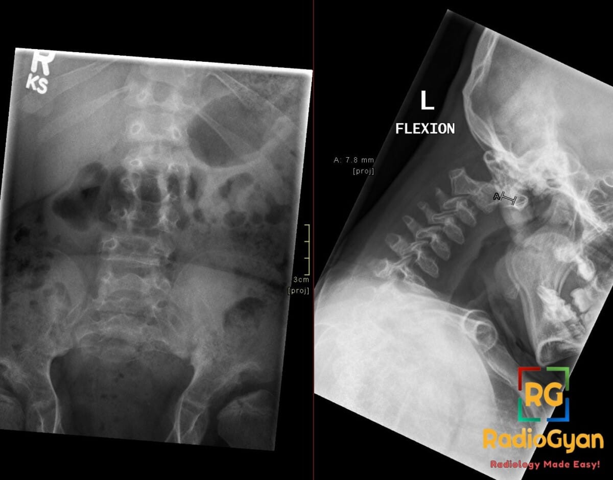 X-ray of spine showing anteroinferior beaking in lumbar vertebrae and widened predental space in cervical spine from Hurler Syndrome.
