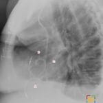 Lateral chest X-ray identifying three replaced cardiac valves: tricuspid (A), aortic (B), and mitral (C) valves.
