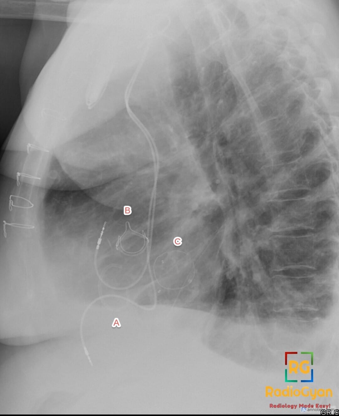 Lateral chest X-ray identifying three replaced cardiac valves: tricuspid (A), aortic (B), and mitral (C) valves.