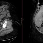 CT abdomen showing an incarcerated umbilical hernia with dilated bowel loops within the hernia sac, indicating bowel obstruction.