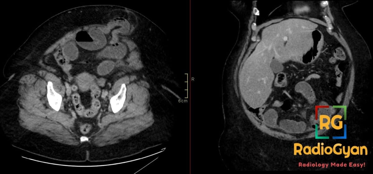 CT abdomen showing an incarcerated umbilical hernia with dilated bowel loops within the hernia sac, indicating bowel obstruction.