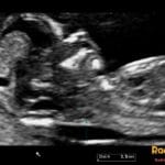 Ultrasound image of a first-trimester fetus showing increased nuchal translucency measurement of 3.5mm.