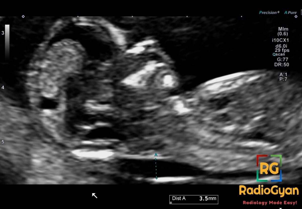 Ultrasound image of a first-trimester fetus showing increased nuchal translucency measurement of 3.5mm.