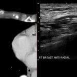 Ultrasound and CT scan showing intracapsular breast implant rupture with the classic step-ladder sign.