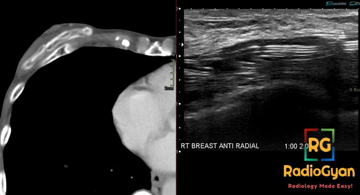 Ultrasound and CT scan showing intracapsular breast implant rupture with the classic step-ladder sign.