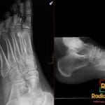 AP and lateral ankle X-ray views showing a Jones fracture at the base of the fifth metatarsal.