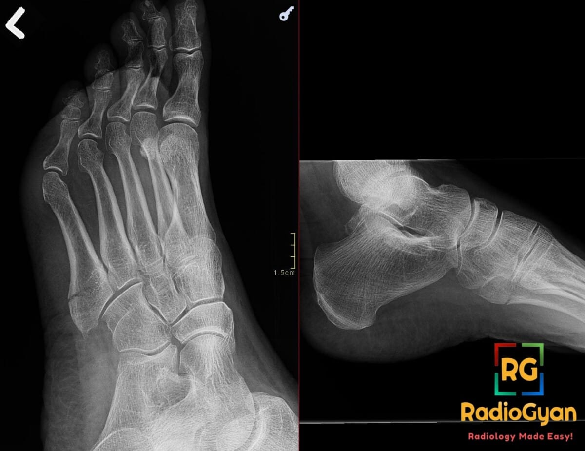 AP and lateral ankle X-ray views showing a Jones fracture at the base of the fifth metatarsal.