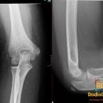 AP and lateral elbow X-rays of a 7-year-old showing a lateral epicondyle avulsion fracture with no lipohemarthrosis.