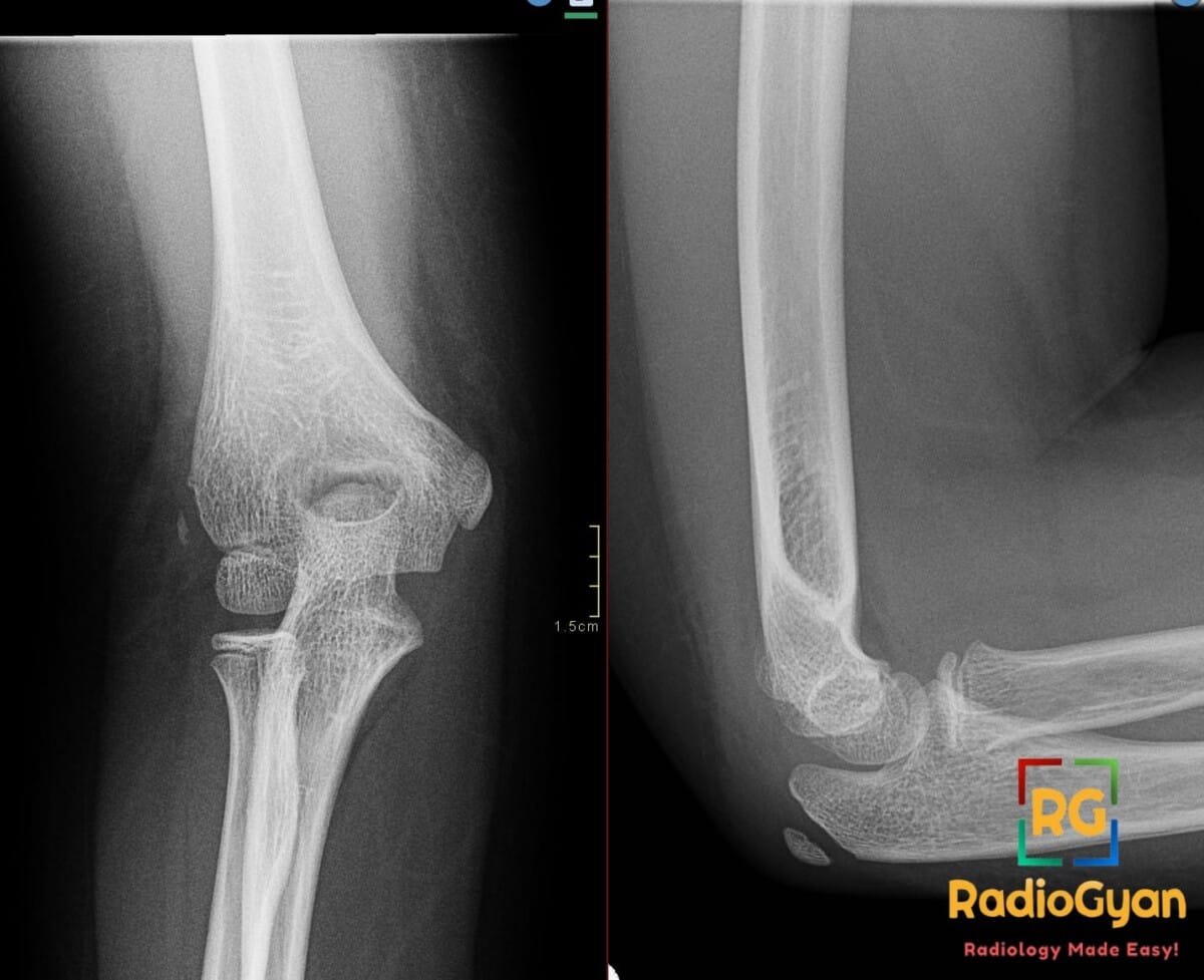 AP and lateral elbow X-rays of a 7-year-old showing a lateral epicondyle avulsion fracture with no lipohemarthrosis.