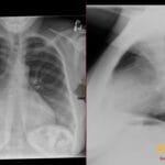 PA and lateral chest radiograph showing severe left atrial enlargement with a prominent double density sign.