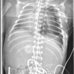 Chest X-ray showing left deep sulcus sign from moderate left pneumothorax with midline shift in neonate