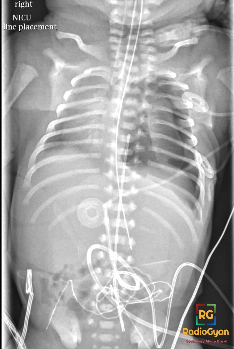 Chest X-ray showing left deep sulcus sign from moderate left pneumothorax with midline shift in neonate