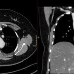 Axial and coronal CT chest images showing left-sided superior vena cava (SVC), a normal variant.