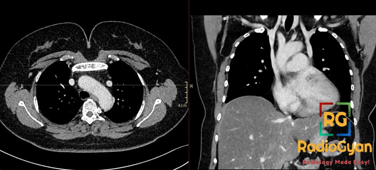 Axial and coronal CT chest images showing left-sided superior vena cava (SVC), a normal variant.