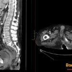 Sagittal and axial CT images showing a malpositioned Foley catheter with its balloon in the penile urethra and a posterior pressure ulcer.