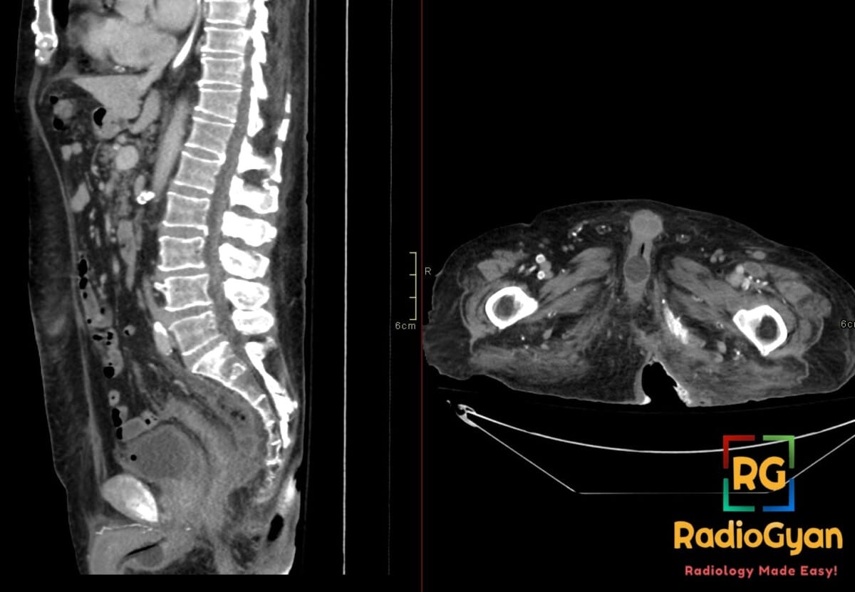 Sagittal and axial CT images showing a malpositioned Foley catheter with its balloon in the penile urethra and a posterior pressure ulcer.