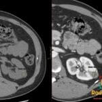 Axial CT scan demonstrating papillary renal cell carcinoma in the left kidney with low-grade enhancement.