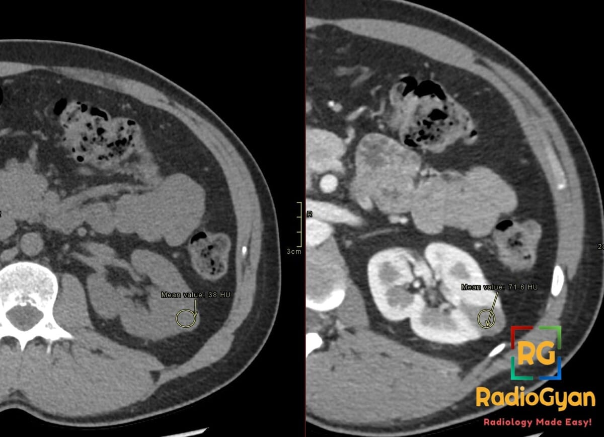 Axial CT scan demonstrating papillary renal cell carcinoma in the left kidney with low-grade enhancement.