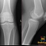 AP and lateral knee X-rays showing a Pellegrini-Stieda lesion, indicating prior MCL injury with abnormal ossification.