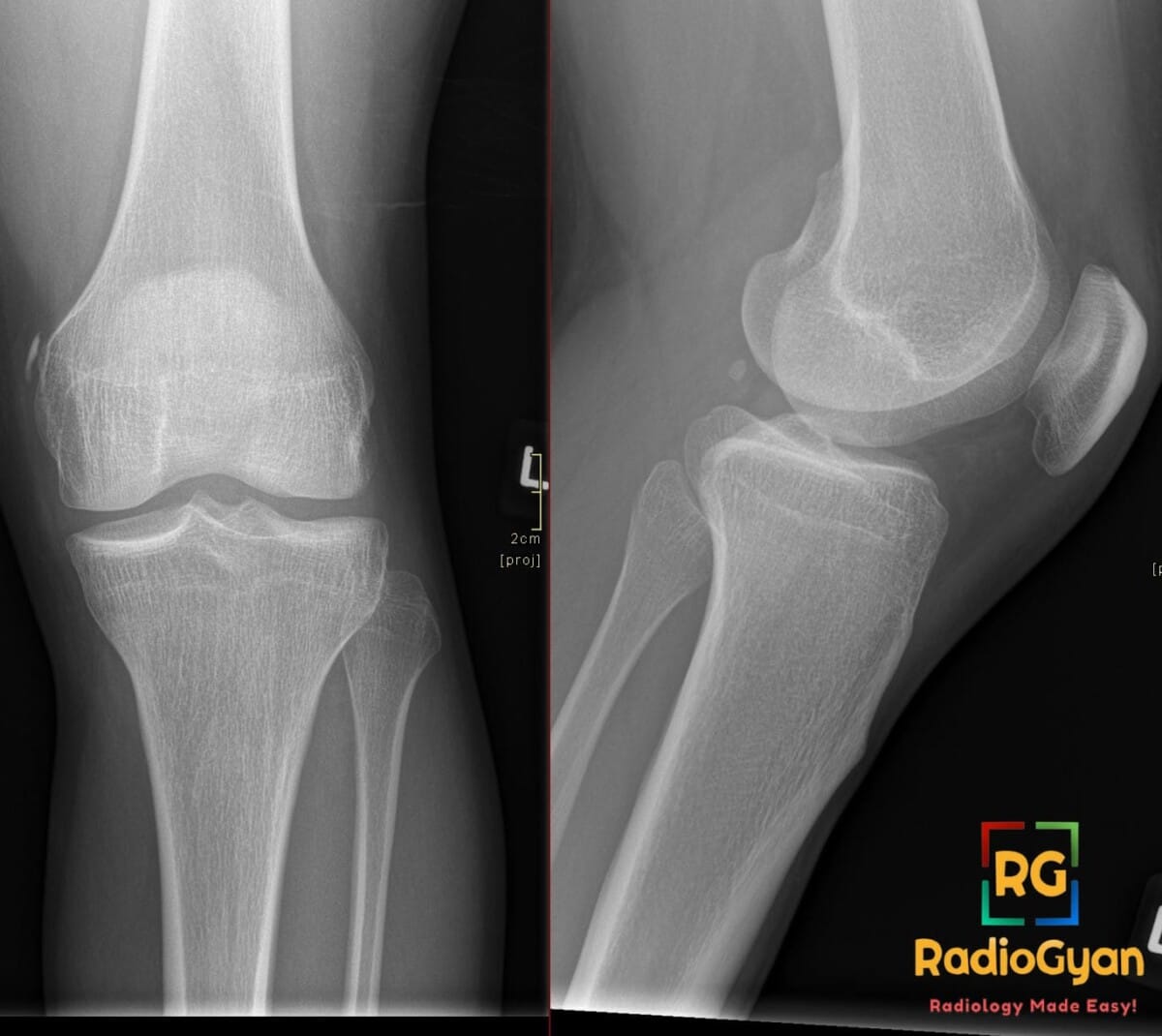 AP and lateral knee X-rays showing a Pellegrini-Stieda lesion, indicating prior MCL injury with abnormal ossification.