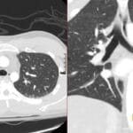 Axial and coronal chest CT scans demonstrating a tracheal bronchus (pig bronchus) arising from the right tracheal wall.