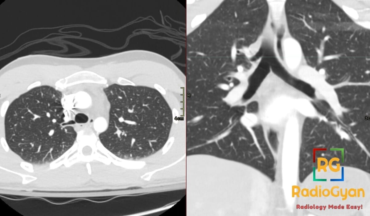 Axial and coronal chest CT scans demonstrating a tracheal bronchus (pig bronchus) arising from the right tracheal wall.