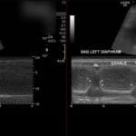 Ultrasound M-mode showing right diaphragm paralysis with no excursion, compared to normal motion of the left diaphragm.