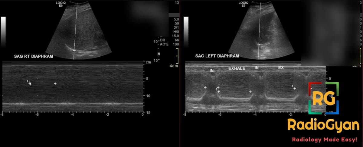 Ultrasound M-mode showing right diaphragm paralysis with no excursion, compared to normal motion of the left diaphragm.