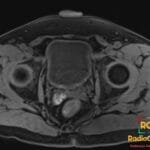 Axial T1 fat-saturated MRI showing right seminal vesicle hemorrhage in a patient with hematospermia.