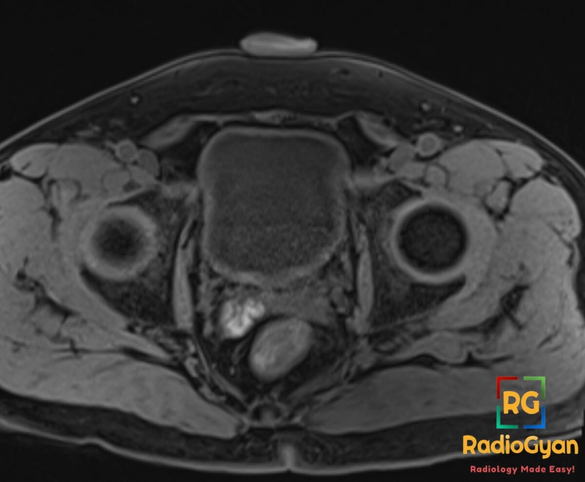 Axial T1 fat-saturated MRI showing right seminal vesicle hemorrhage in a patient with hematospermia.