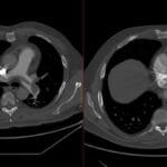 Axial CT pulmonary angiogram showing a large saddle thrombus and findings of right ventricular strain.