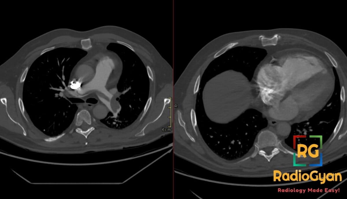 Axial CT pulmonary angiogram showing a large saddle thrombus and findings of right ventricular strain.