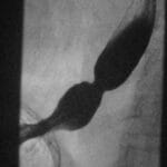 Barium swallow study showing a sliding hiatal hernia with a Schatzki B ring at the gastroesophageal junction.