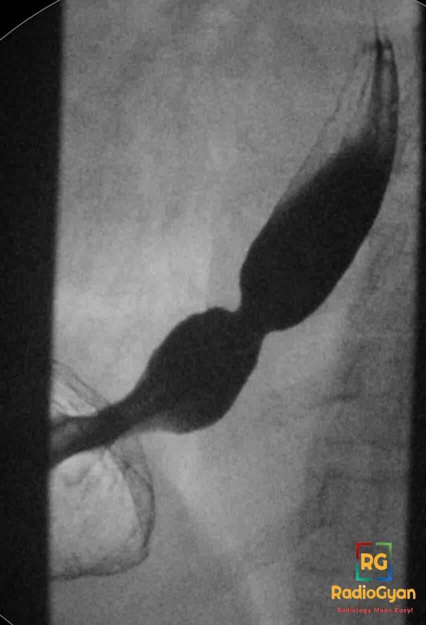 Barium swallow study showing a sliding hiatal hernia with a Schatzki B ring at the gastroesophageal junction.