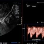 Endovaginal ultrasound showing succenturate lobe with vasa previa and color Doppler vessels near cervix
