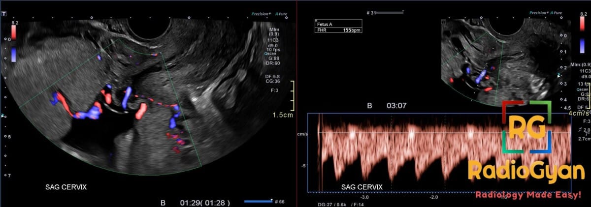 Endovaginal ultrasound showing succenturate lobe with vasa previa and color Doppler vessels near cervix