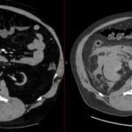 Axial CT showing a right-sided perinephric hematoma (58 HU) indicating Wunderlich syndrome in an atrophic kidney.