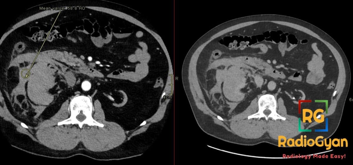 Axial CT showing a right-sided perinephric hematoma (58 HU) indicating Wunderlich syndrome in an atrophic kidney.