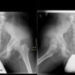 Pediatric AP and frog-leg pelvic X-rays showing bilateral developmental hip dysplasia, right worse than left.