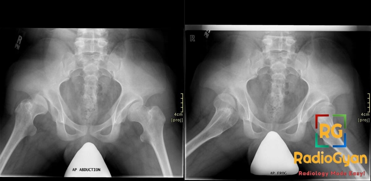 Pediatric AP and frog-leg pelvic X-rays showing bilateral developmental hip dysplasia, right worse than left.