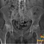 Pelvic X-ray showing bilateral femoral head avascular necrosis with collapse and sclerosis