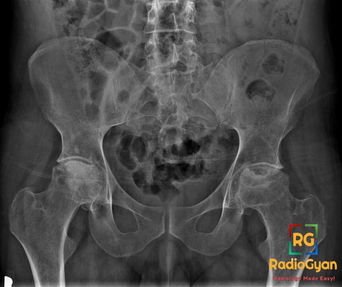 Pelvic X-ray showing bilateral femoral head avascular necrosis with collapse and sclerosis