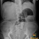 Abdominal X-ray showing bilateral varicocele embolization coils in the pelvis and lower abdomen.