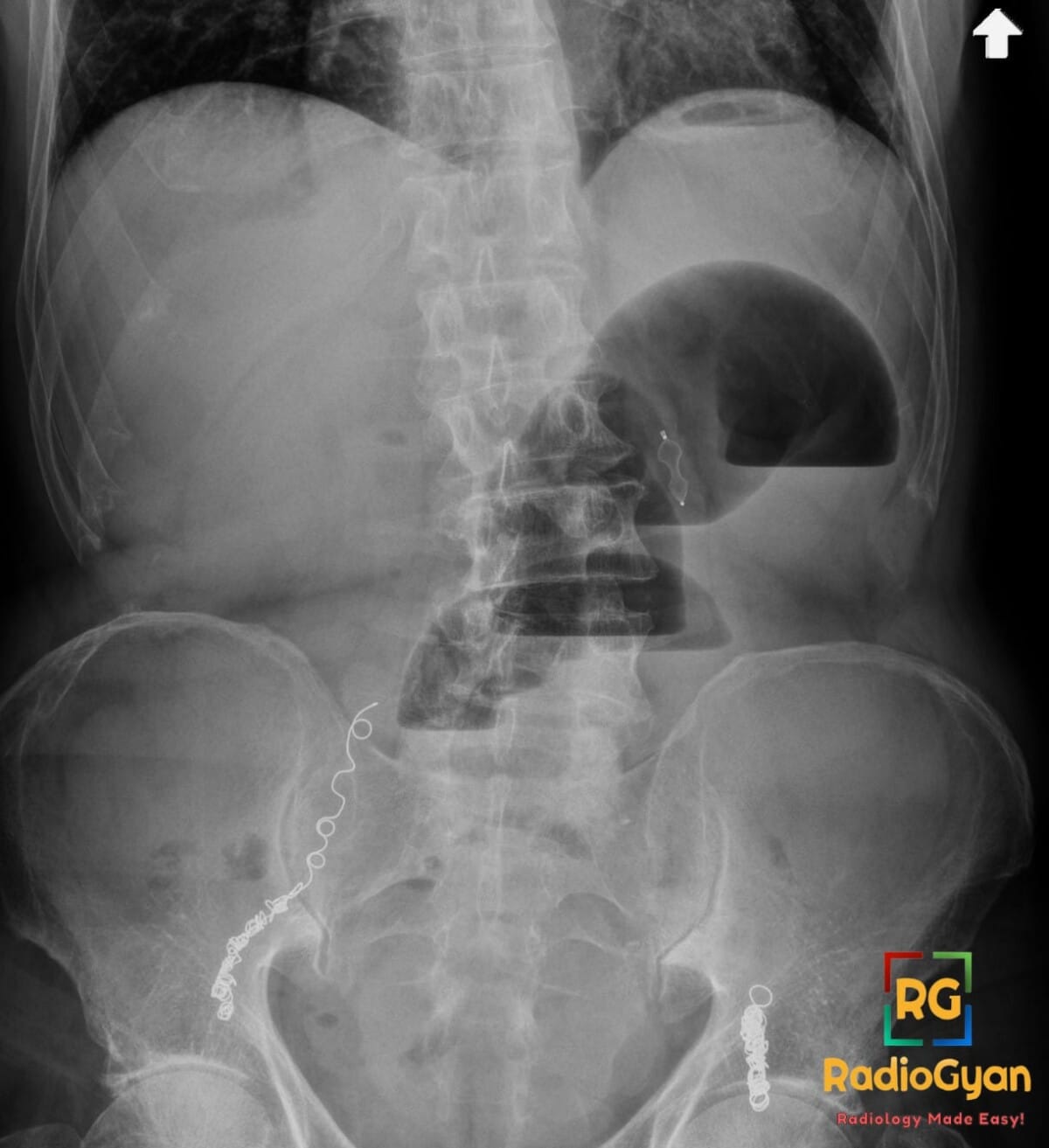 Abdominal X-ray showing bilateral varicocele embolization coils in the pelvis and lower abdomen.