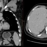 CT scans showing cardiac cirrhosis secondary to Fontan procedure with liver and cardiac findings
